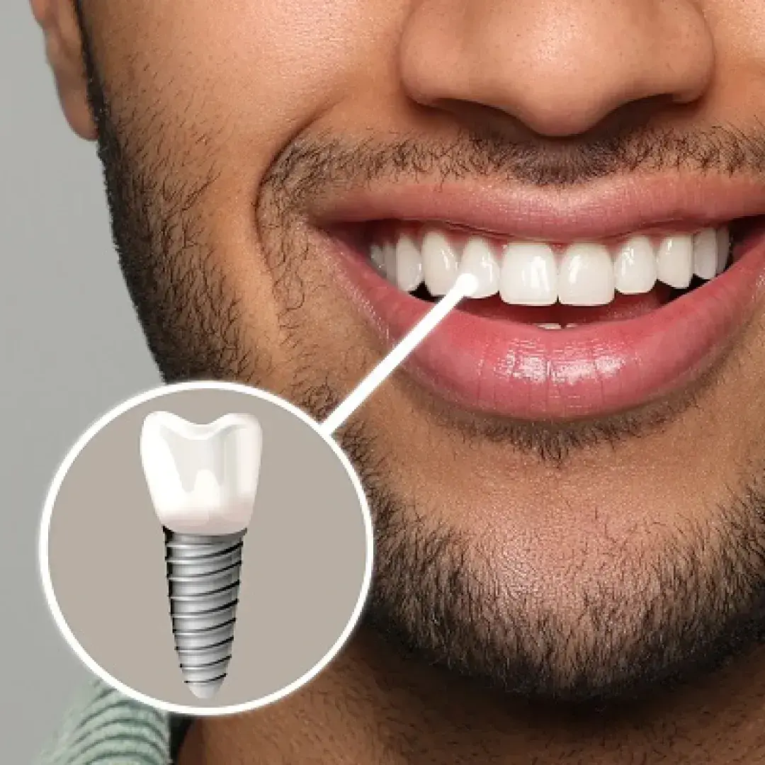 Dental Implants