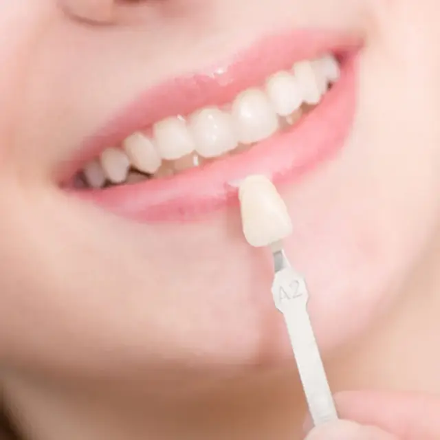 Dental Veneers