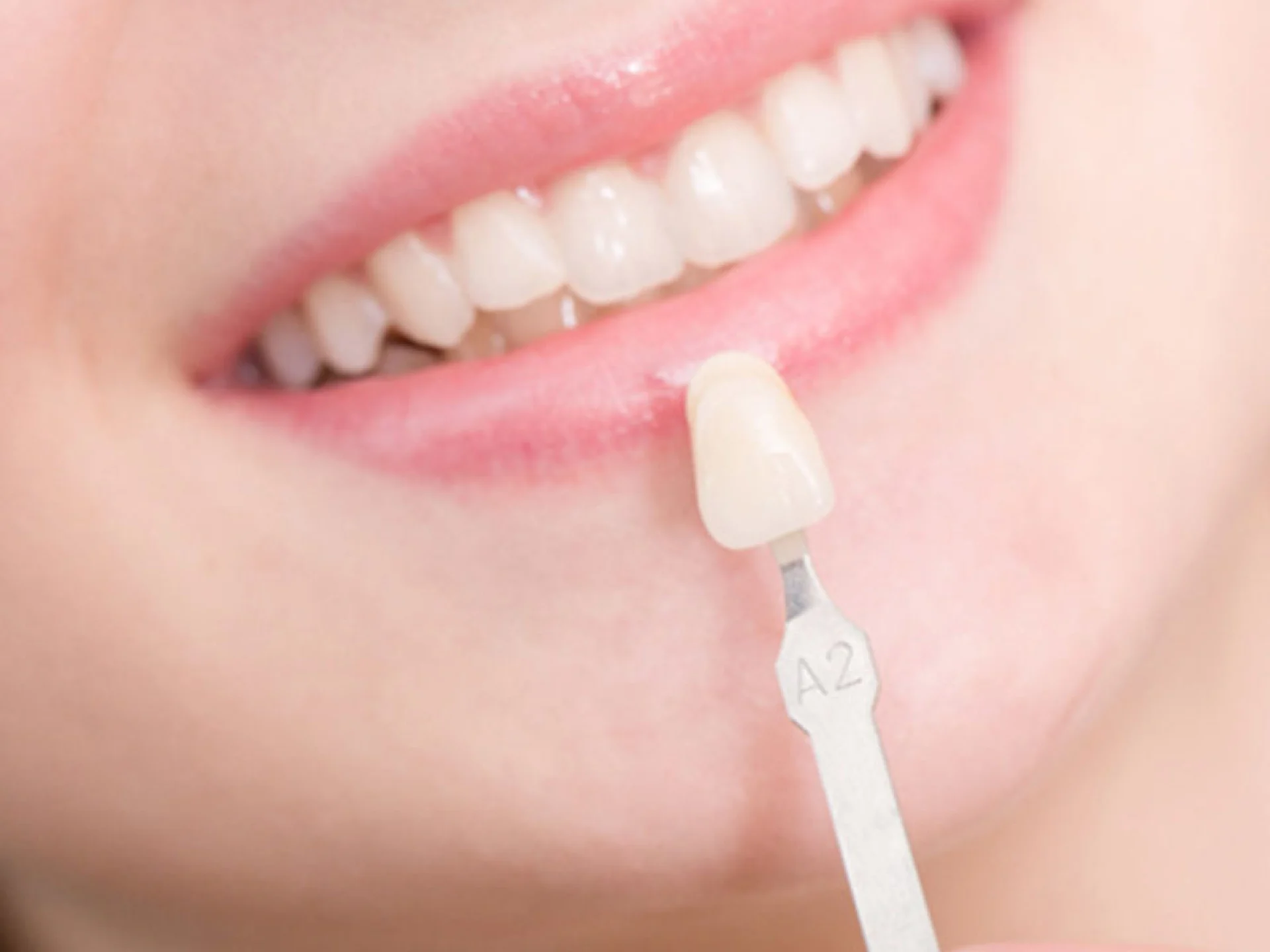 dental veneers desktop